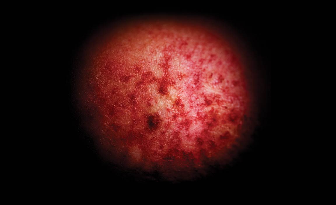 Depiction of radiation effects on tissue.